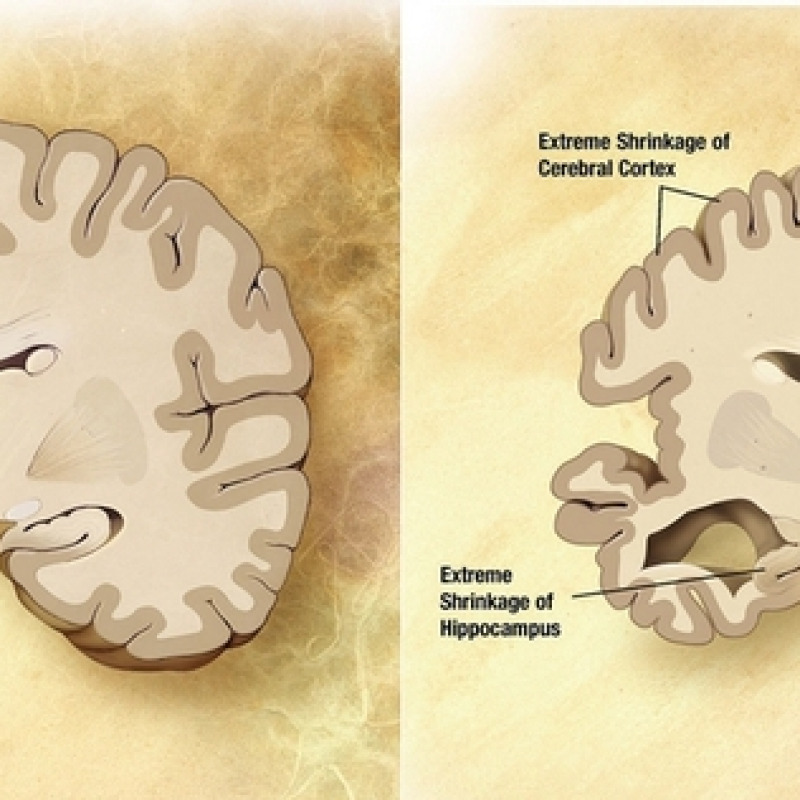 Alzheimer, raffronto tra un cervello sano e uno malato