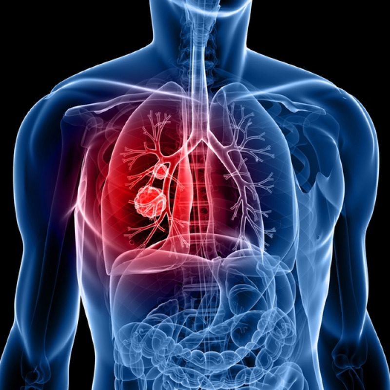 Tumore al polmone