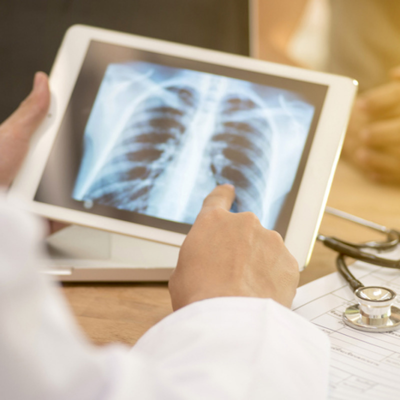Tubercolosi, 2 mln i ragazzi colpiti ogni anno nel mondo